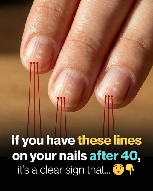 Vertical Lines on Your Nails: Why They Appear and How to Care for Them