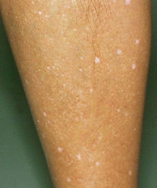 White Spots on the Skin: Causes, Nutrients, and When to Seek Care