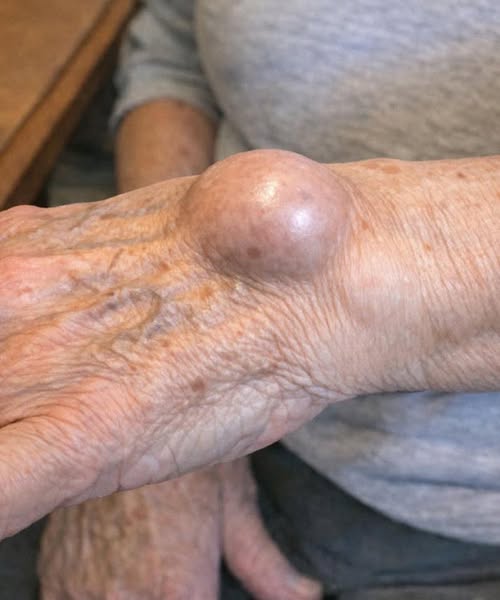 A Practical Guide to Understanding a Sudden Lump on Your Wrist