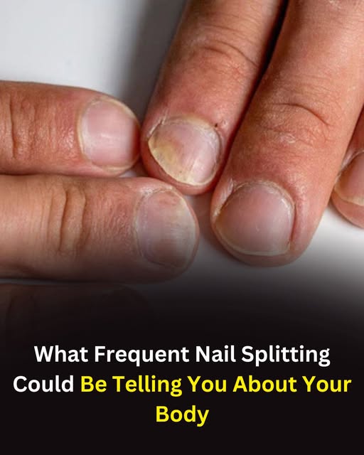 When Nails Split Easily: What Your Body May Be Telling You