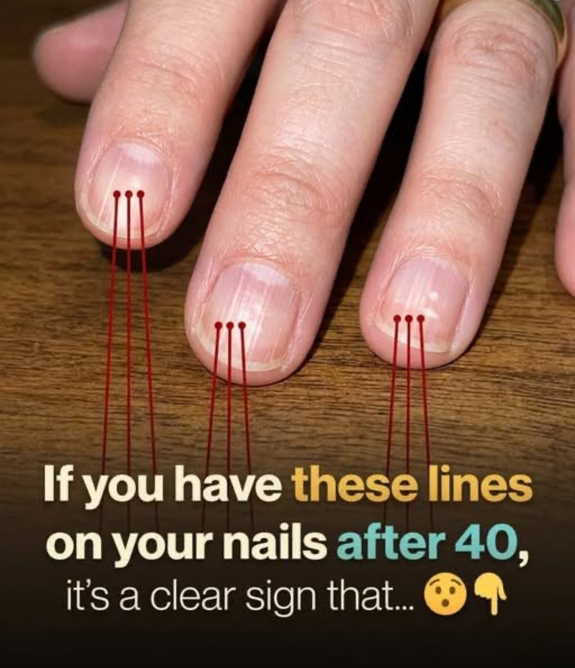 Vertical Lines on Fingernails: What They Often Mean and How to Care for Your Nails