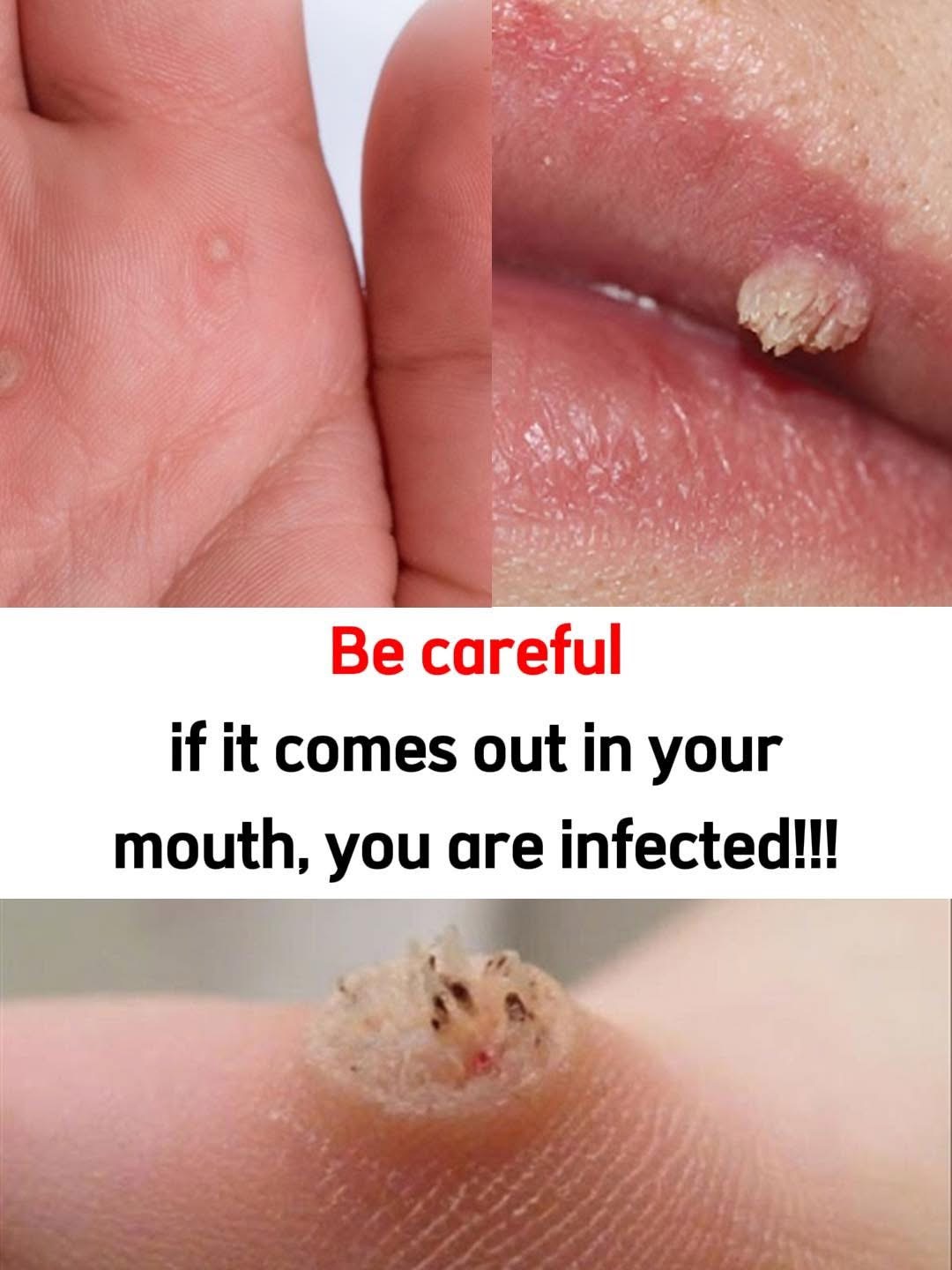 A Gentle, Step-by-Step Approach to Managing Warts at Home