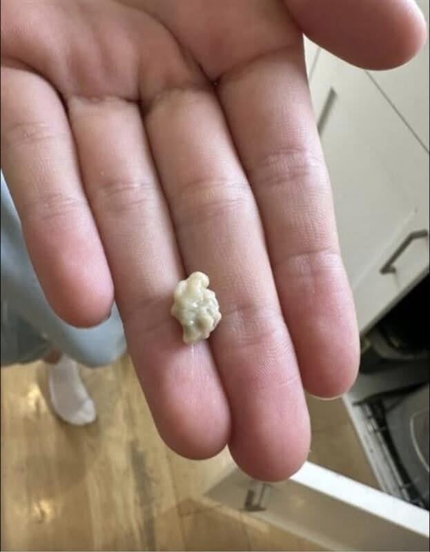 Understanding Tonsil Stones: A Practical Guide Behind a Viral Trend