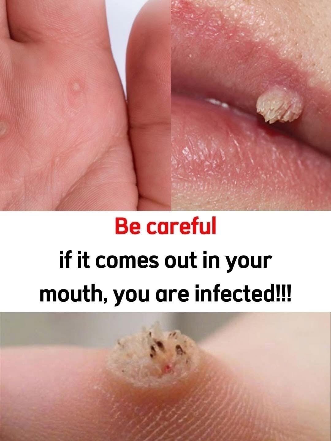 Natural Wart Care: A Practical Guide to Simple, Consistent Solutions