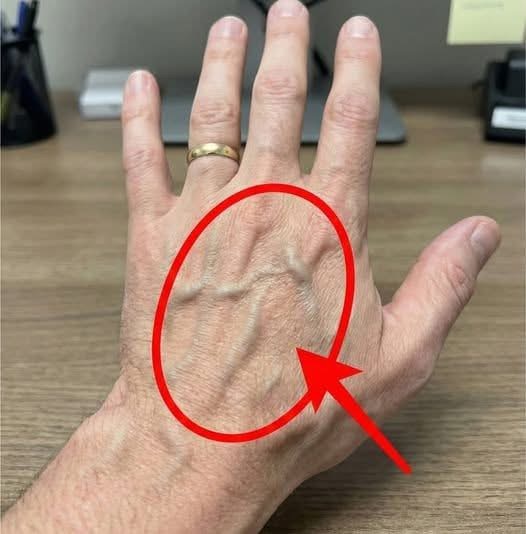 Why Hand Veins Can Look More Visible—and What It Usually Means