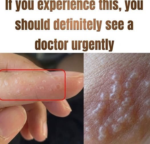 Managing Dyshidrotic Eczema: Practical Steps for Everyday Comfort