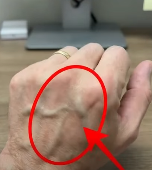 What More Visible Veins Can Tell You About Your Body