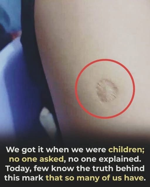 The Small Scar That Tells a Remarkable Story of Global Health
