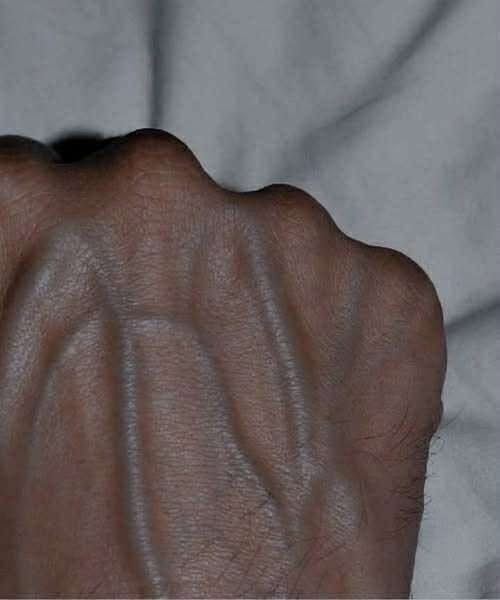 Why Veins on the Hands May Be More Visible Than You Think