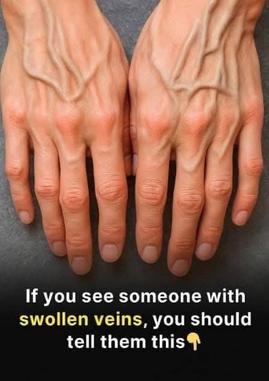 What Do Visible Veins Really Mean? Understanding the Causes and When to Pay Attention